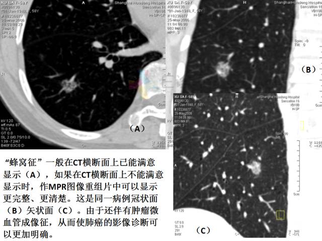 【PPT】微小肺癌的CT形态学分型
