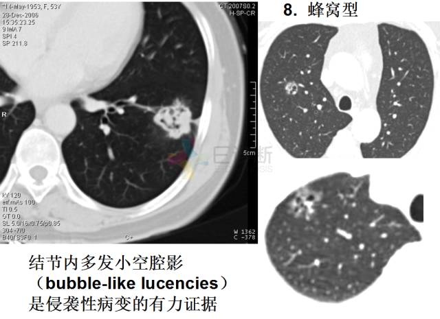 【PPT】微小肺癌的CT形态学分型