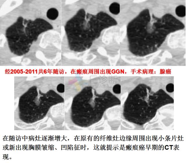 【PPT】微小肺癌的CT形态学分型