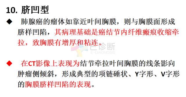 【PPT】微小肺癌的CT形态学分型