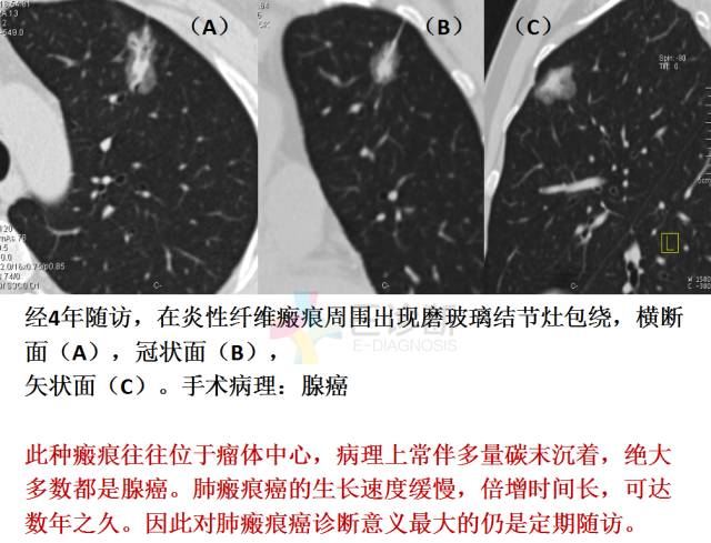 【PPT】微小肺癌的CT形态学分型