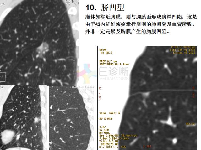 【PPT】微小肺癌的CT形态学分型