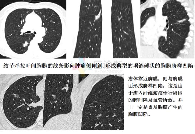 【PPT】微小肺癌的CT形态学分型