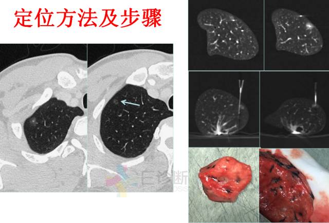 【PPT】微小肺癌的CT形态学分型