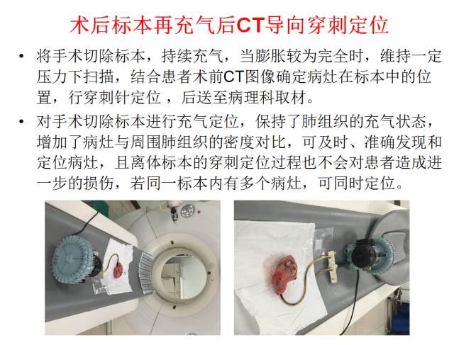 【PPT】微小肺癌的CT形态学分型