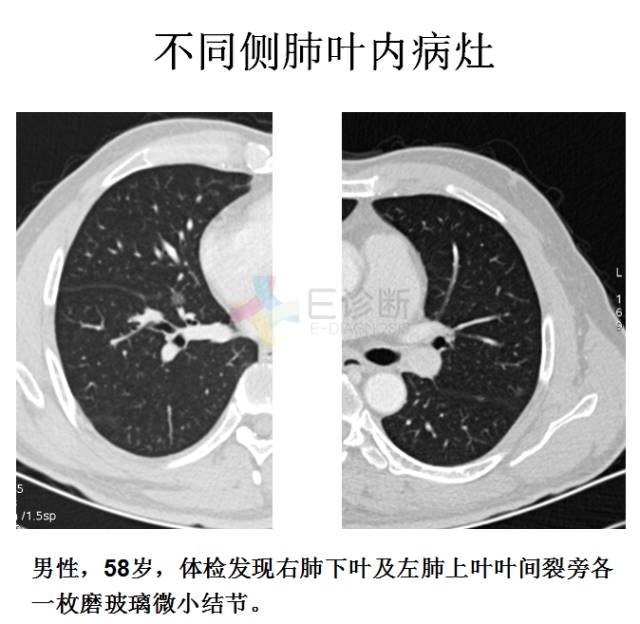 【PPT】微小肺癌的CT形态学分型