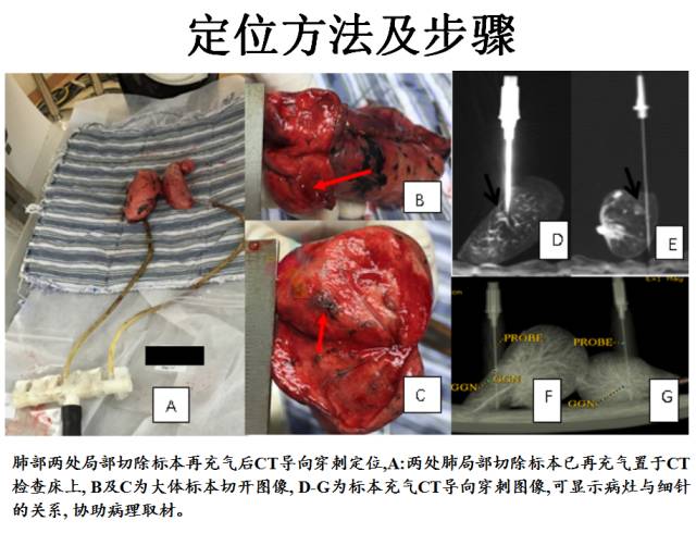 【PPT】微小肺癌的CT形态学分型