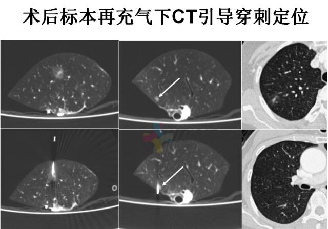 【PPT】微小肺癌的CT形态学分型