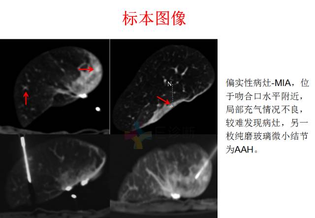【PPT】微小肺癌的CT形态学分型