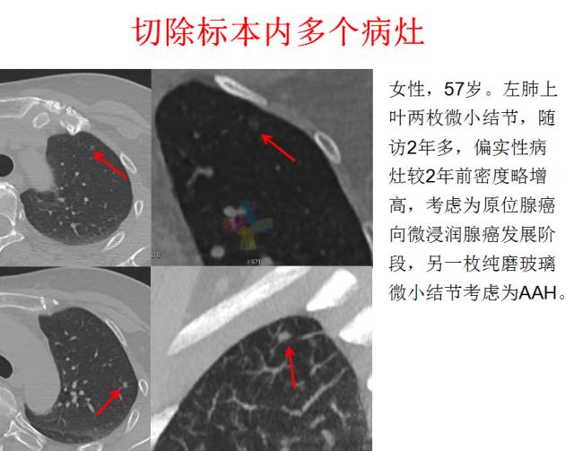 【PPT】微小肺癌的CT形态学分型