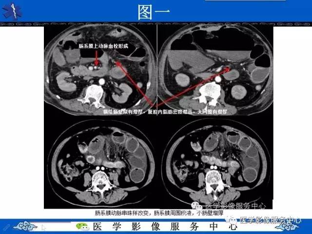 【影像征象】肠系膜混浊征