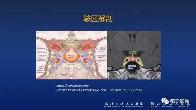 【PPT】侵袭性垂体瘤MRI与临床