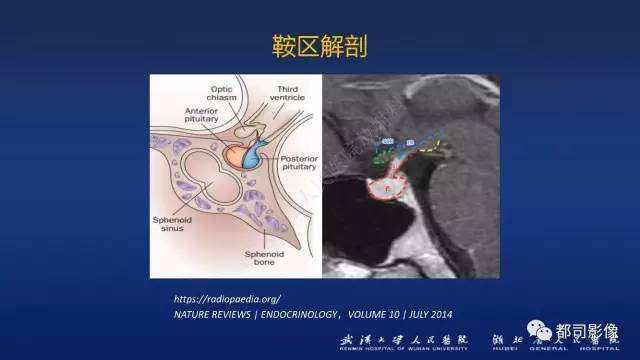 【PPT】侵袭性垂体瘤MRI与临床