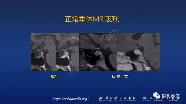 【PPT】侵袭性垂体瘤MRI与临床
