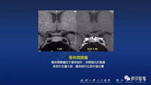【PPT】侵袭性垂体瘤MRI与临床