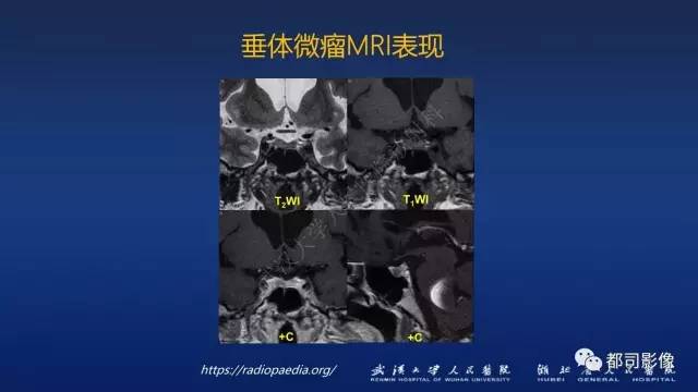 【PPT】侵袭性垂体瘤MRI与临床