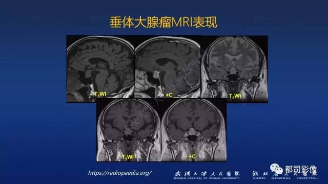【PPT】侵袭性垂体瘤MRI与临床