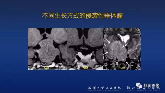 【PPT】侵袭性垂体瘤MRI与临床