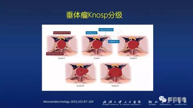 【PPT】侵袭性垂体瘤MRI与临床