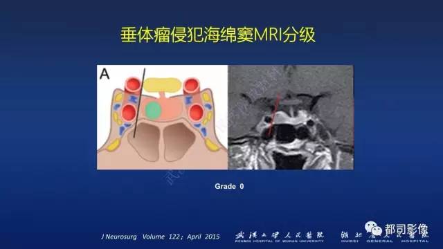 【PPT】侵袭性垂体瘤MRI与临床