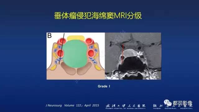【PPT】侵袭性垂体瘤MRI与临床