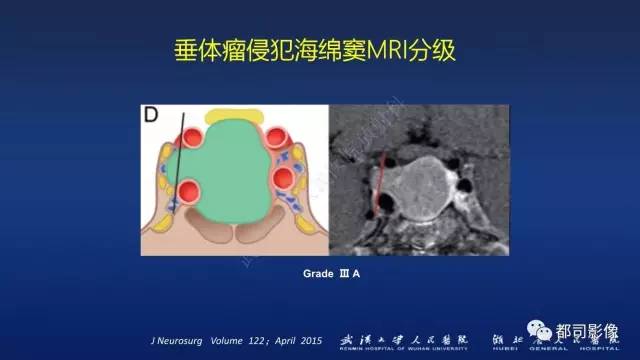 【PPT】侵袭性垂体瘤MRI与临床