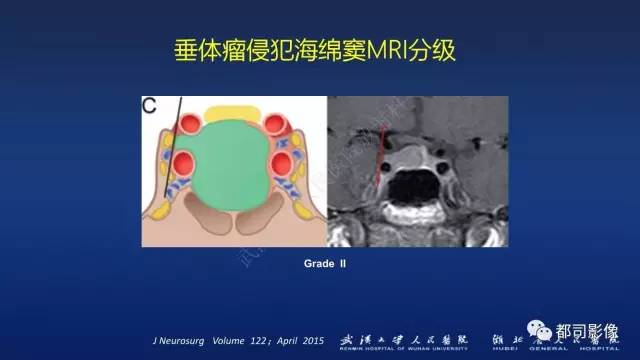 【PPT】侵袭性垂体瘤MRI与临床