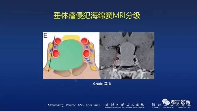【PPT】侵袭性垂体瘤MRI与临床