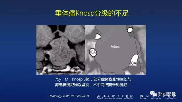【PPT】侵袭性垂体瘤MRI与临床