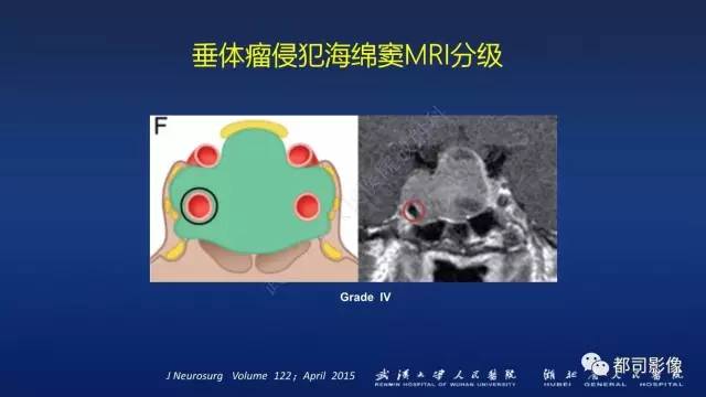 【PPT】侵袭性垂体瘤MRI与临床