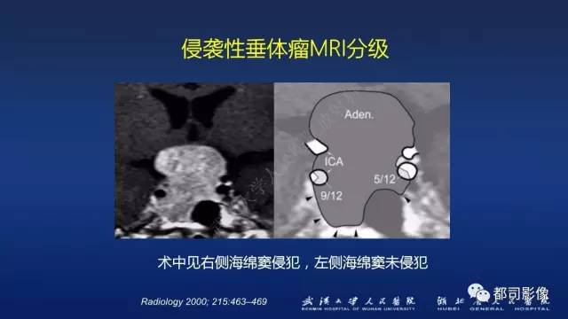 【PPT】侵袭性垂体瘤MRI与临床