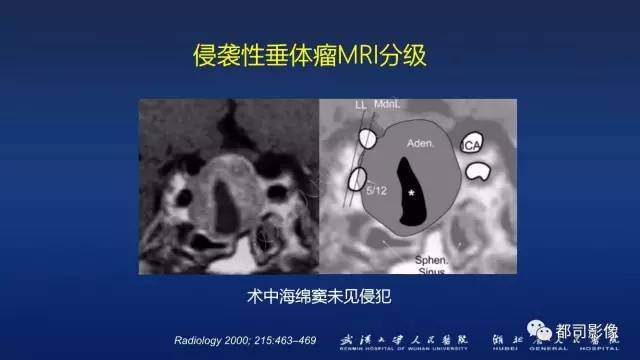 【PPT】侵袭性垂体瘤MRI与临床