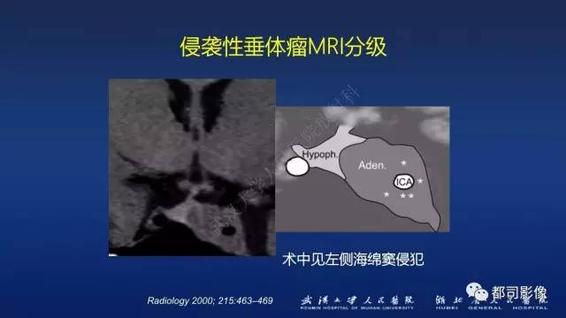 【PPT】侵袭性垂体瘤MRI与临床