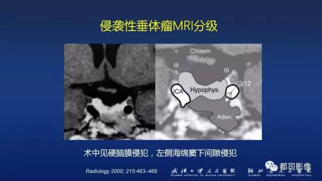 【PPT】侵袭性垂体瘤MRI与临床
