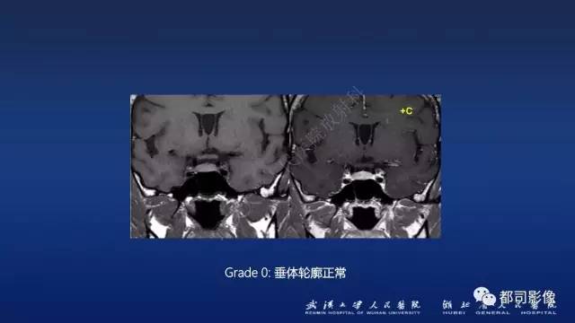 【PPT】侵袭性垂体瘤MRI与临床
