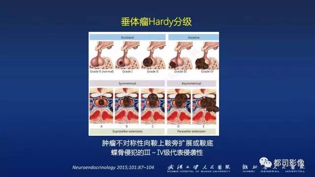 【PPT】侵袭性垂体瘤MRI与临床
