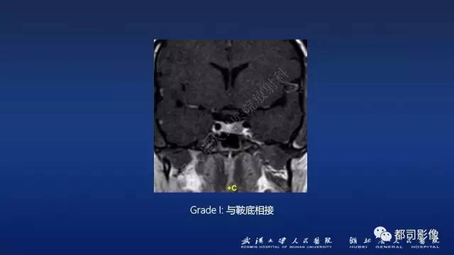 【PPT】侵袭性垂体瘤MRI与临床