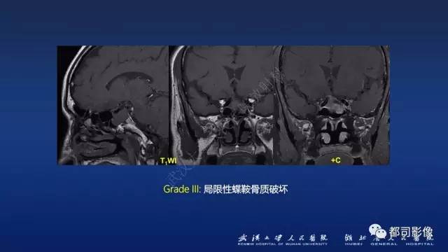 【PPT】侵袭性垂体瘤MRI与临床