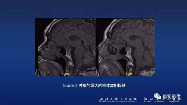 【PPT】侵袭性垂体瘤MRI与临床