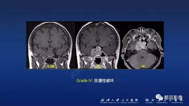 【PPT】侵袭性垂体瘤MRI与临床