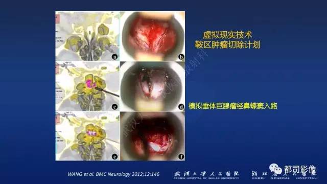 【PPT】侵袭性垂体瘤MRI与临床