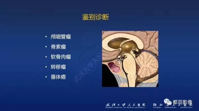 【PPT】侵袭性垂体瘤MRI与临床