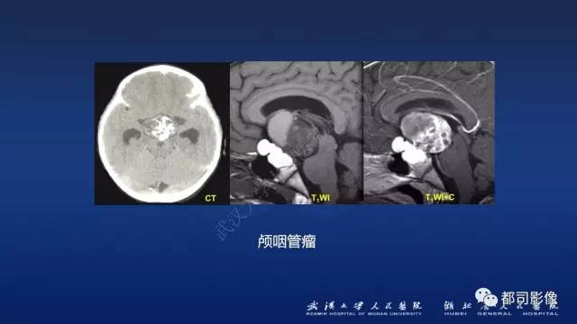 【PPT】侵袭性垂体瘤MRI与临床