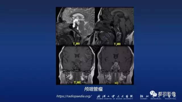 【PPT】侵袭性垂体瘤MRI与临床