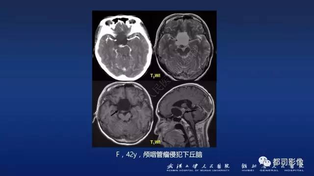 【PPT】侵袭性垂体瘤MRI与临床