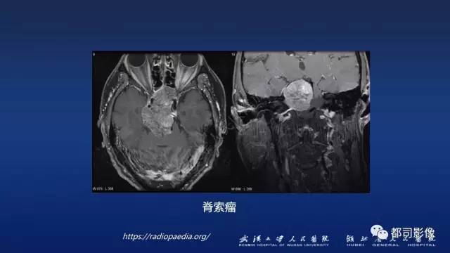 【PPT】侵袭性垂体瘤MRI与临床