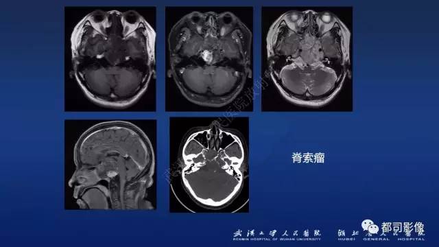 【PPT】侵袭性垂体瘤MRI与临床