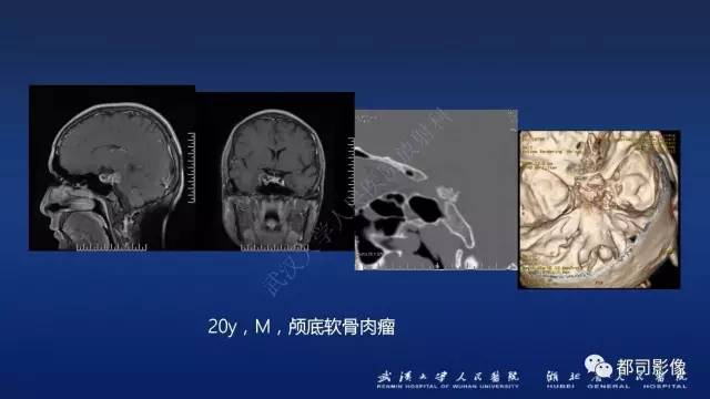 【PPT】侵袭性垂体瘤MRI与临床