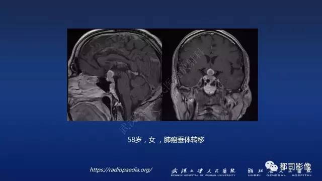 【PPT】侵袭性垂体瘤MRI与临床