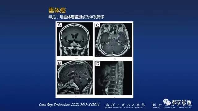 【PPT】侵袭性垂体瘤MRI与临床